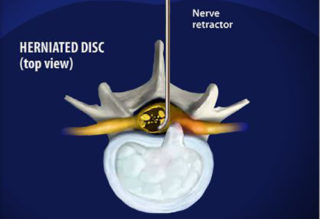 http://miamibrowardhomes.com/socphysicians/wp-content/uploads/2017/01/lumbar-micro-discectomy-320x219.jpg