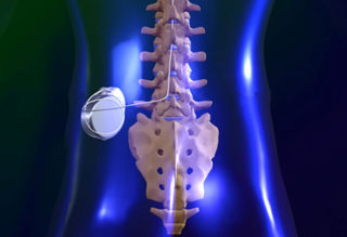 http://miamibrowardhomes.com/socphysicians/wp-content/uploads/2017/01/spinal-cord-stimulation-implants-320x219.jpg